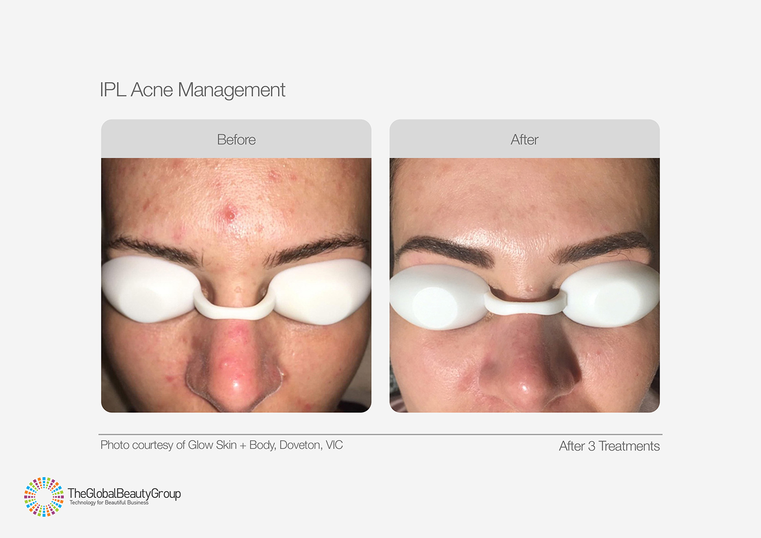 IPL Acne Management Before After Forehead