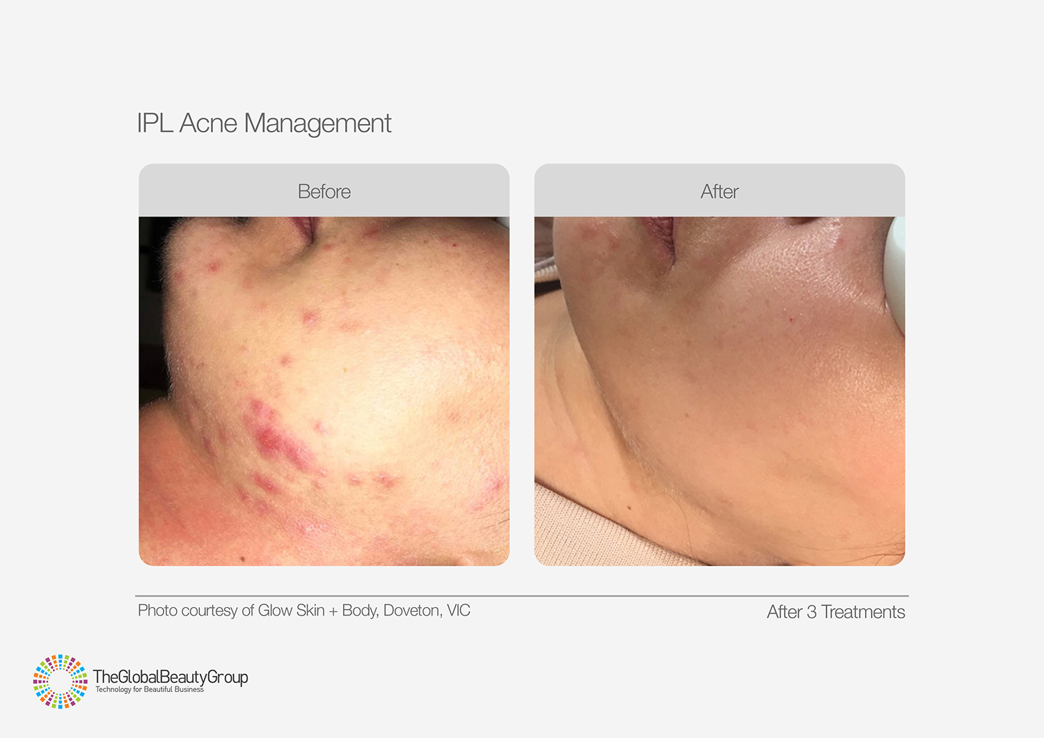 IPL Acne Management Before After Jaw Neck