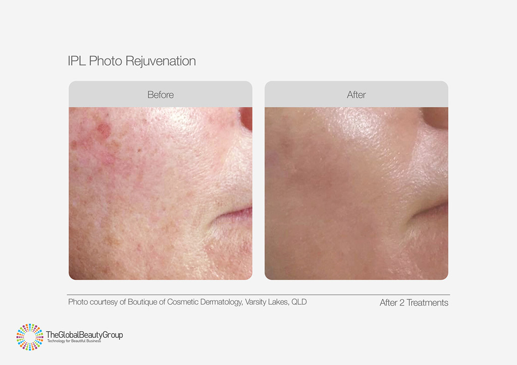 IPL Photo Rejuvenation Before After Pigment and Red Blotches