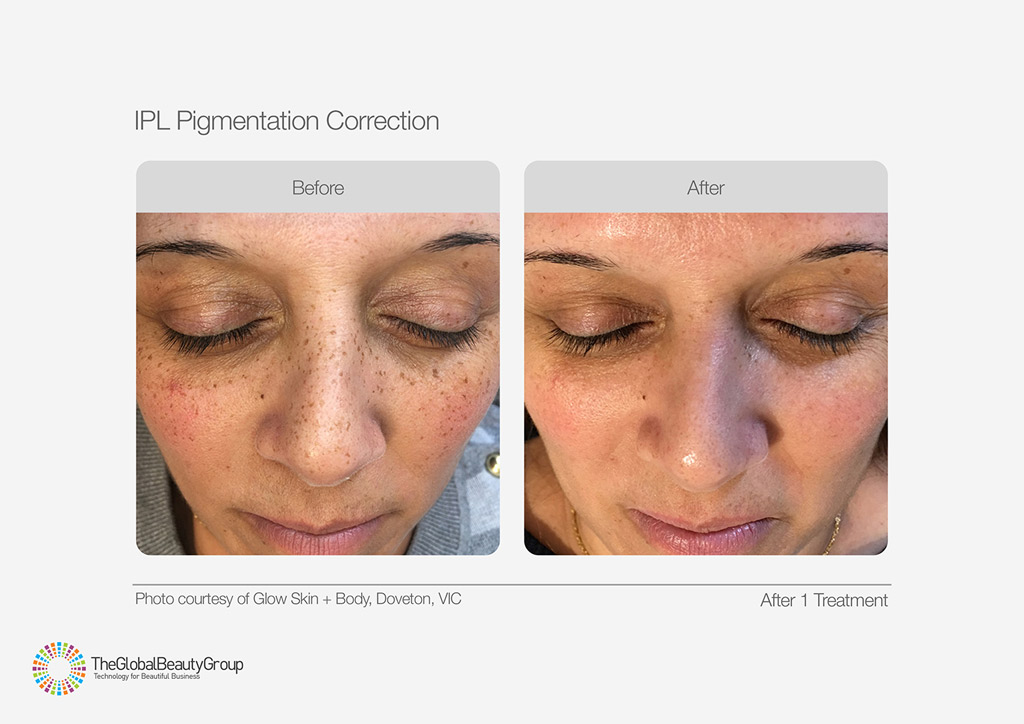 IPL Pigmentation Correction Before After Cheeks