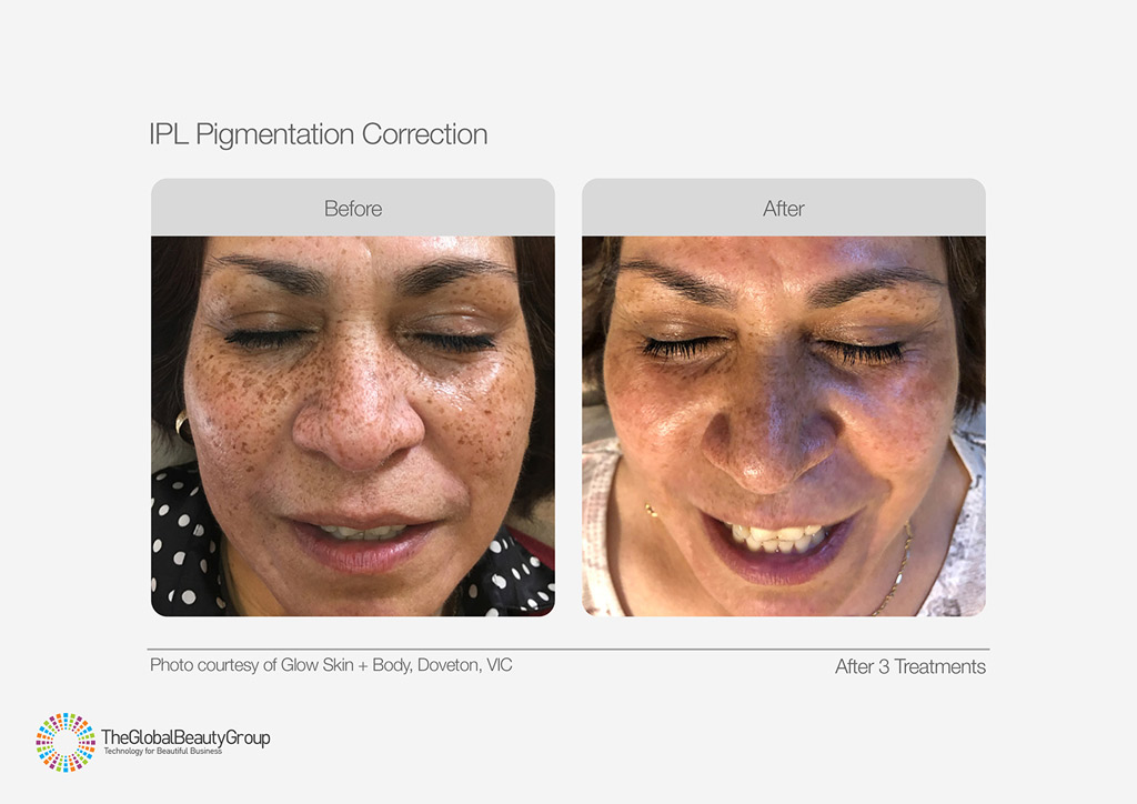 IPL Pigmentation Correction Before After Ethnic Face