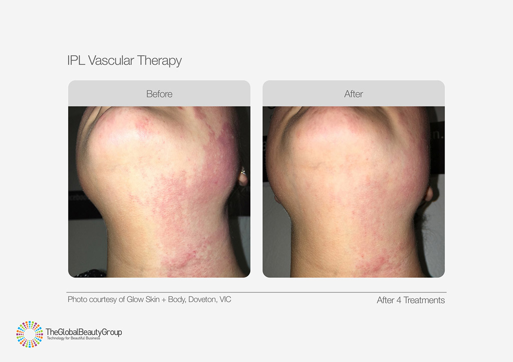 IPL Vascular Therapy Before After Cheeck and Neck Redness