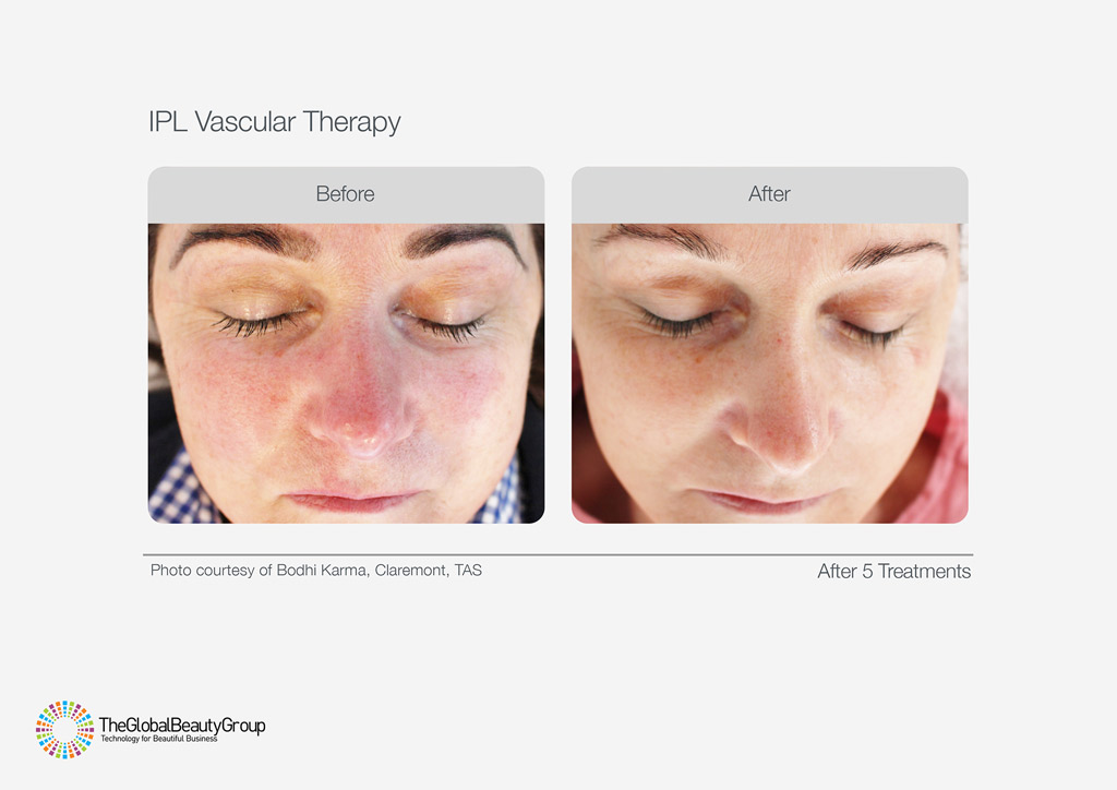 IPL Vascular Therapy Before After Facial Redness