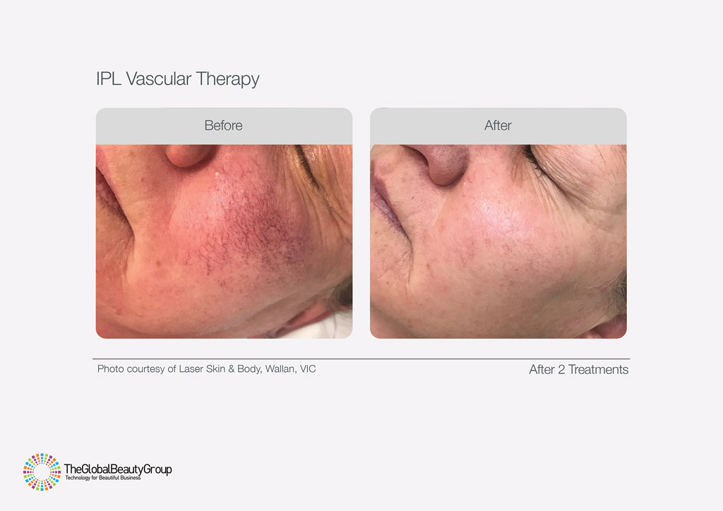 IPL Vascular Therapy Before After Lady Cheeks