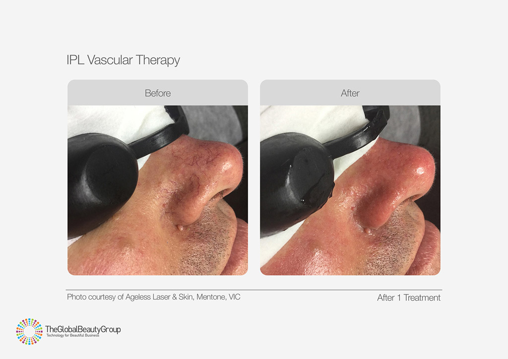 IPL Vascular Therapy Before After Male Nose