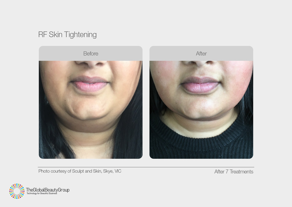 RF Skin Tightening Before After Chin Jowls