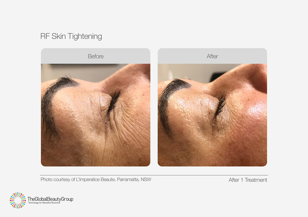 RF Skin Tightening Before After Face Eyes