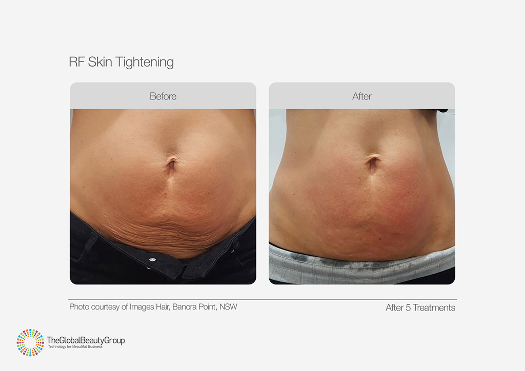 RF Skin Tightening Before After Tummy