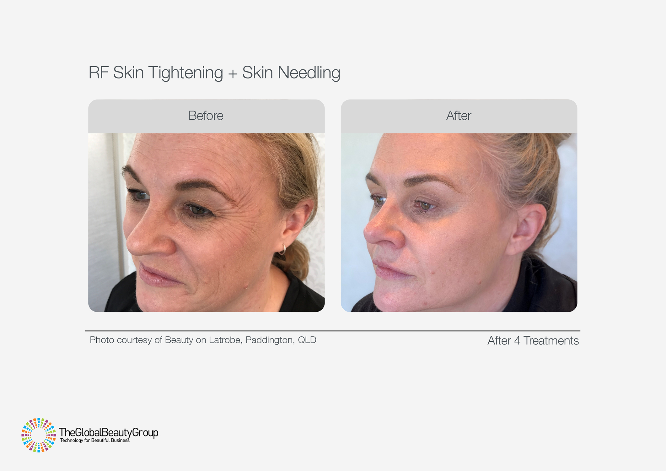 RF Skin Tightening and Skin Needling Before After Face