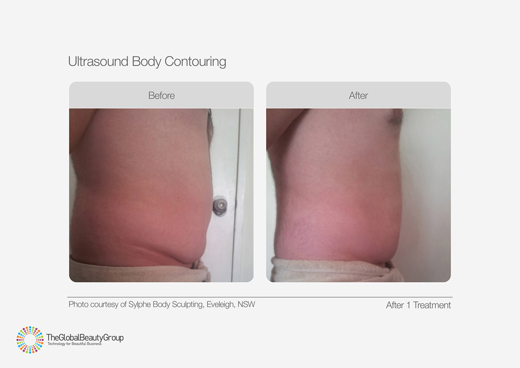 Ultrasound Body Contouring Before After Male Tummy