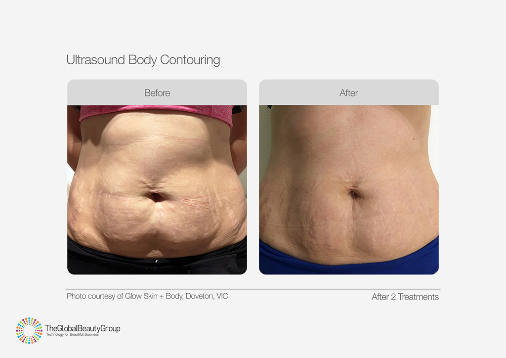 Ultrasound Body Contouring Before After Womans Tummy