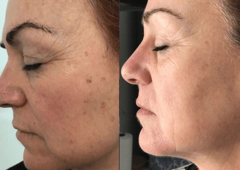 Anti-Ageing-Treatments-woodlands